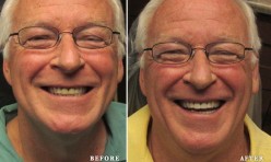 Before & After