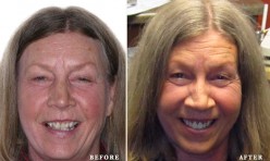 Before & After