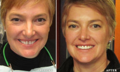 Before & After