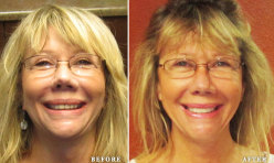 Before & After